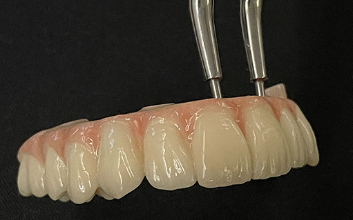 occlusion model by Dr. Winderbaum 