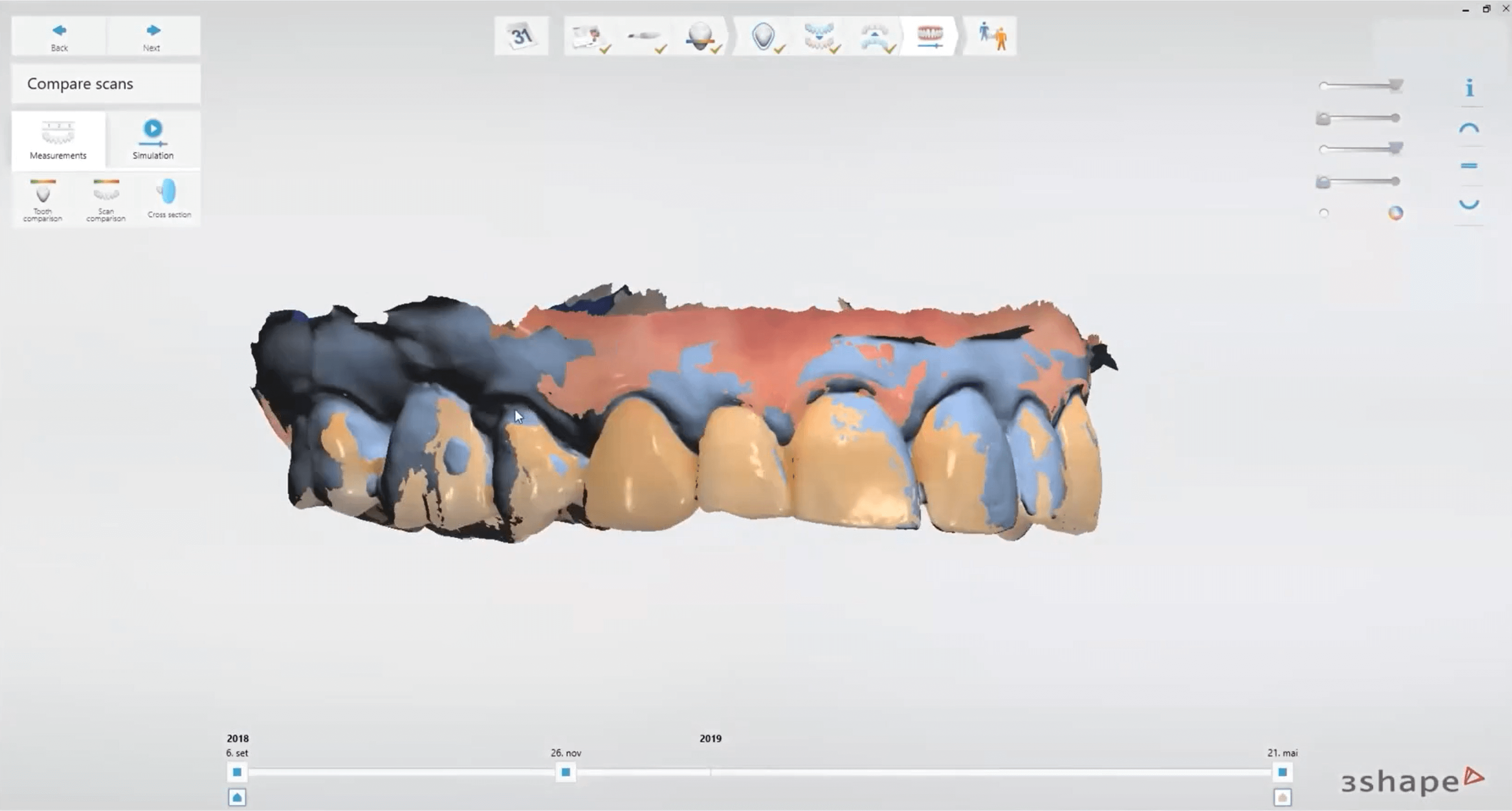 Holes in teeth scan TRIOS patient monitoring