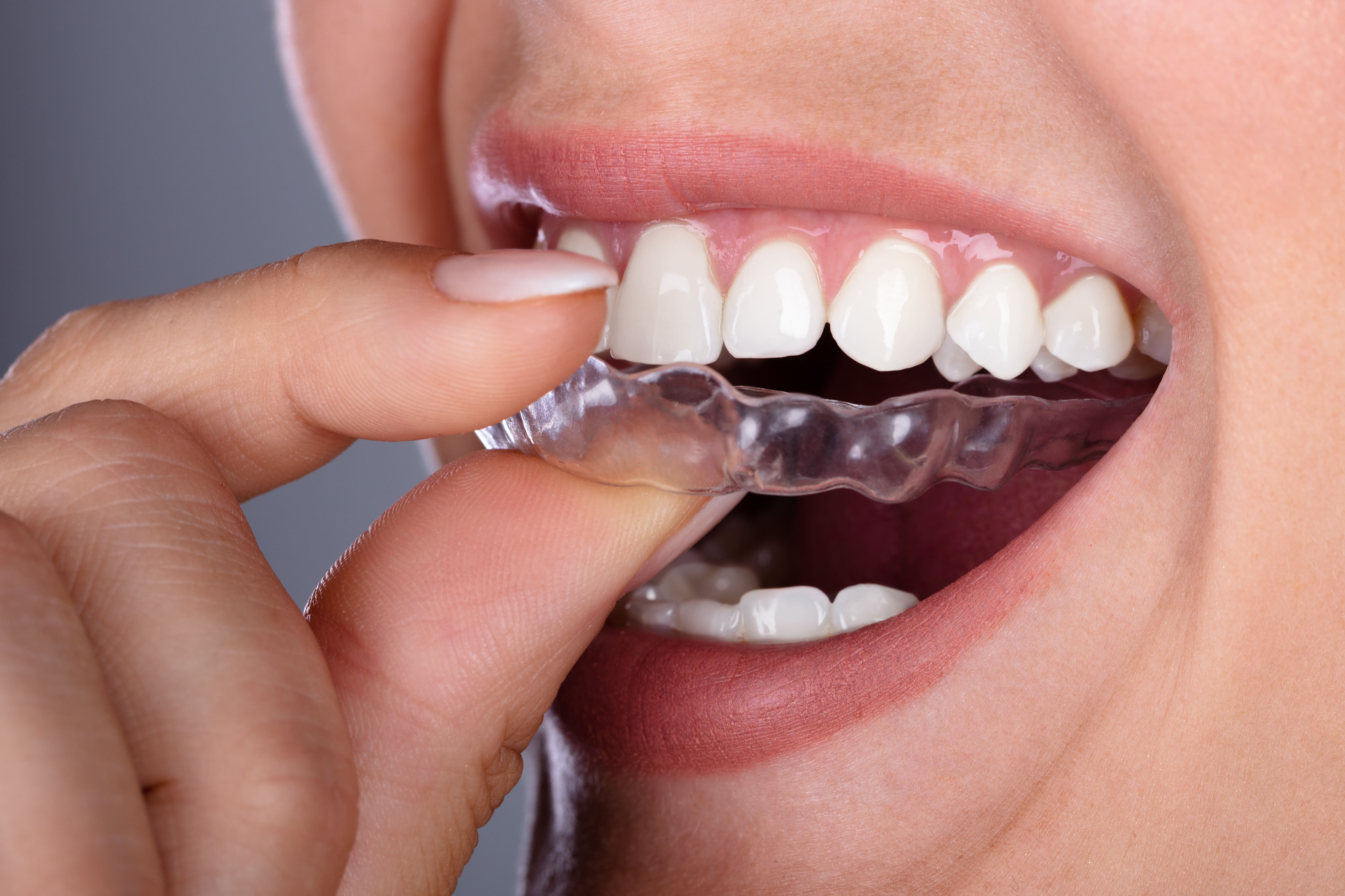 Clear aligners