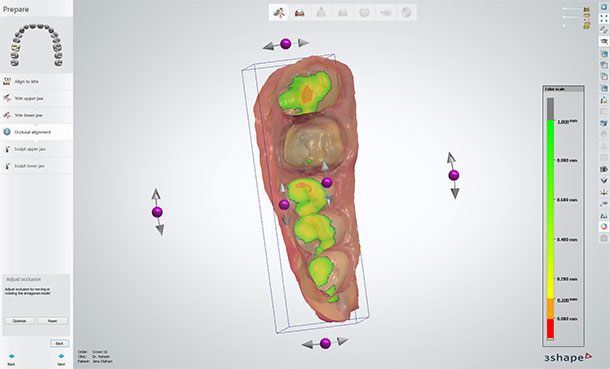 Check the static occlusion of the bite scan