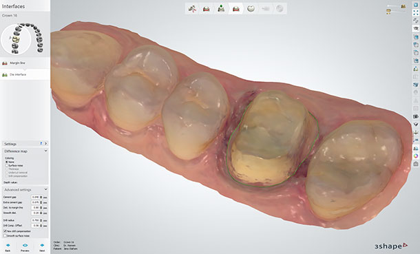 Determine and set your cement-gap parameters