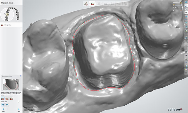 Determining the margin line