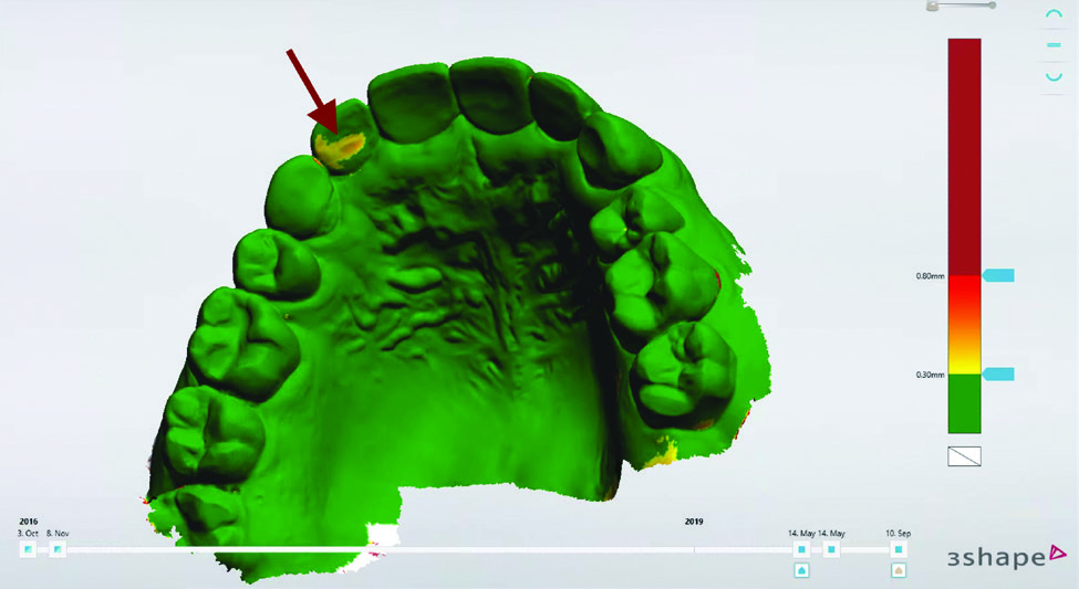 Digital dental monitoring with the 3Shape software